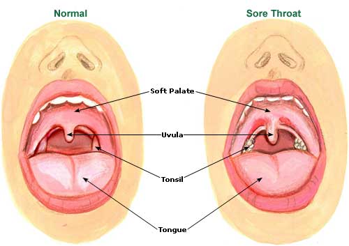 Sore Throat - Causes, Symptoms and Effective Treatment
